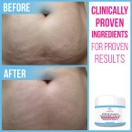 100% Retinol Free Stretch Mark Cream for Pregnancy & Scar Removal Online in UAE