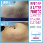 100% Retinol Free Stretch Mark Cream for Pregnancy & Scar Removal Online in UAE