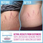 100% Retinol Free Stretch Mark Cream for Pregnancy & Scar Removal Online in UAE