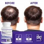 Propidren by HairGenics - DHT Blocker with Saw Palmetto To Prevent Hair Loss and Stimulate Hair Follicles to Stop Hair Loss and Regrow Hair.