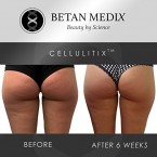 Buy Betan MediX  Cellulite Cream and Massager Online in UAE