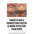 SkinPro EXTREME Skin Tag Remover & Mole Corrector - Fast Acting Physician Level 3 Formula, Industry Leading 25% Pure Salicylic Acid Concentration