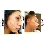 The Ordinary Retinol 1% in Squalane 30ml