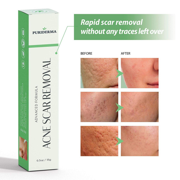 High Quality Acne Scar Removal Cream Treatment F..