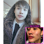 Buy Acne Erasing Emulsion by Evanesce New York Online in UAE