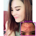 Buy Acne Erasing Emulsion by Evanesce New York Online in UAE