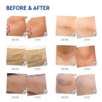 Buy Reusable Silicone Scar Removal Sheets by Tatyana Naturals Cure for Stretch Marks, Surgery Scars, C-Section, Acne Scars