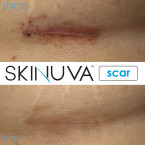  Skinuva Scar Reducing Cream - Formulated with Vitamin C Sale in UAE