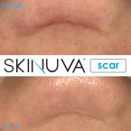  Skinuva Scar Reducing Cream - Formulated with Vitamin C Sale in UAE