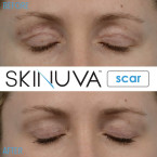  Skinuva Scar Reducing Cream - Formulated with Vitamin C Sale in UAE