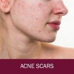 Herbal Removal Cream for Face & Body - Advanced Scar Repair Treatment for New and Old Scars Shop in UAE