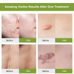  Natural Scar Removal Gel | Acne Scar Treatment Sale in UAE