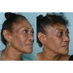 Buy dEpPatch DARK SPOT CORRECTOR Lightening Spot Cream For Face and Body Online in UAE