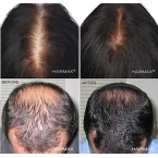 Buy Hairmax Laserband 82 Fastest Laser Hair Loss Treatment For Sale In UAE