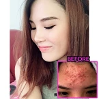 Buy Acne Erasing Emulsion by Evanesce New York Online in UAE