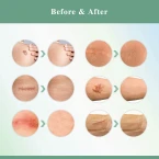 Shop Amada Pure Scar Removal Cream with Natural Herbal Extracts Formula - Effective for Old & New Scars